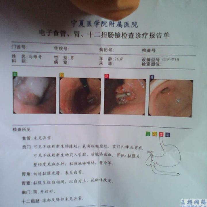 76岁的爷爷患了贲门癌