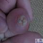 脚趾母上长了个东西，附图