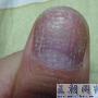 我的指甲怎么了，怎么见人啊