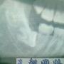 请问大夫，全埋伏性水平阻生的智齿，一定要拔吗？有图，谢谢
