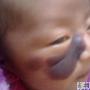 新生婴儿脸上有胎记怎么办？