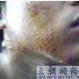 被硝酸烫伤了有图片看我的情况严重吗会留疤吗多久能好