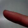手指上长了透明的小泡
