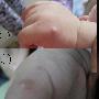 宝宝皮肤红肿起水泡