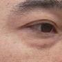 眼袋的问题