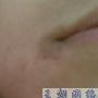 嘴角有黑圈，一直不是很在意，现在都2个月了。怎么有效去除呢，有图片