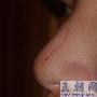鼻子划破了,会不会留疤痕?有图请专家看看