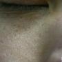 男生脸上长雀斑应该如何治疗？