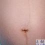 孕妇妊娠纹图片