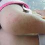 宝宝小腿张一粒粒红疹