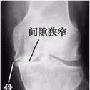 请教腰椎骨质增生怎么治?