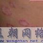 请问我这是属于哪种皮肤病?急！