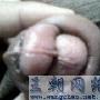 包皮环切术后有个大疙瘩