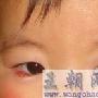 15个月大的小孩眼睛长偷针