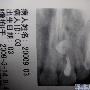 有没有专家看看我的埋伏齿用不用拔出（内有X光片）？？