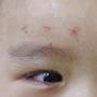 关于上眼睑下垂的问题。