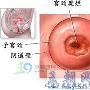 宫颈糜烂怎么治疗？