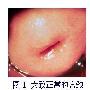 关于宫颈糜烂