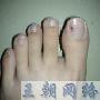 我这是得了灰指甲吗？