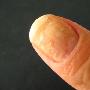 我的打拇指指甲怎么了？