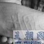 有谁听说过划痕症这个皮肤病吗?