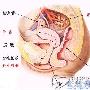 输卵管积水