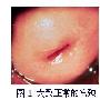 请教重庆妇科专家：有几个关于宫颈糜烂的问题？