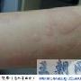 荨麻疹怎么治疗吃什么