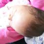 新生儿头皮血肿,较大