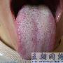 舌苔厚腻怎么办？