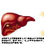 肝病第二大杀手：脂肪肝(图)