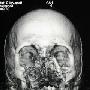 西班牙成功实施全球首宗全脸移植手术(组图)