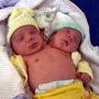 巴西一孕妇产双头婴儿 身体健康用同一心脏