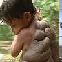 哥伦比亚男孩背部长巨型胎痣形似龟壳(租图)
