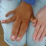 十岁男童患巨指症 手指肥大如香蕉(图)