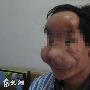 内蒙小伙长罕见的“狮子脸” 有望重回正常