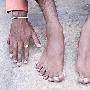 印度一男子先天畸形 长有12个手指和14个脚趾（图）