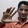 天生12手指14腳趾！印度男子創多指世界記錄（圖）