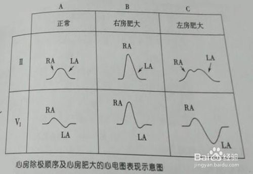 王朝网络 干货 >> 如何看心电图 3:电轴:在一下导联中,qrs波在基线之