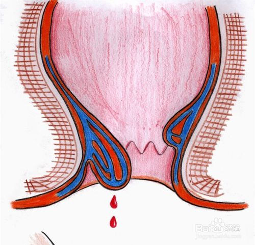 痔疮是怎么得的?怎么防治痔疮?